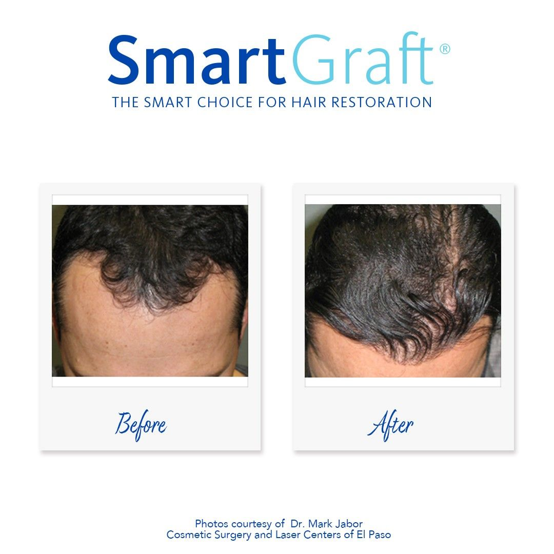 SmartGraft - Image 2